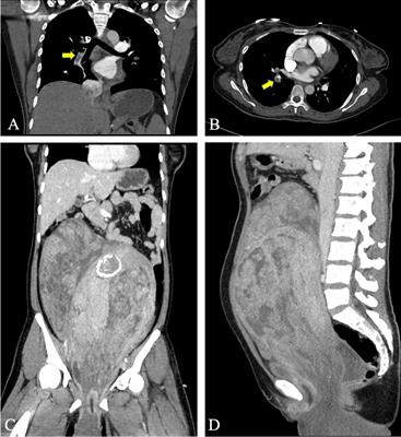 Case report: A case of perineal prolapse of giant uterine fibroids complicated by multiple pulmonary embolisms and deep venous thrombosis